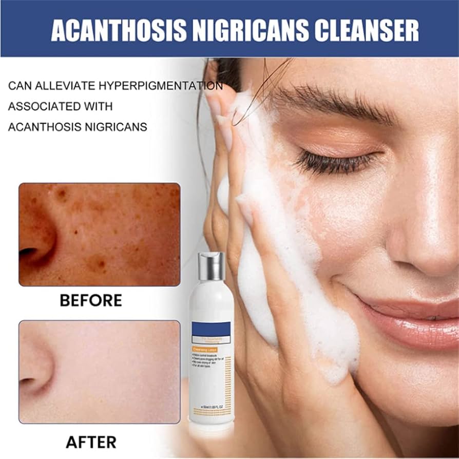 roaccutane comprar online