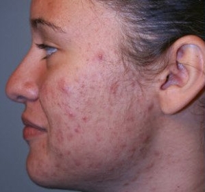 Roaccutane Comprar Online