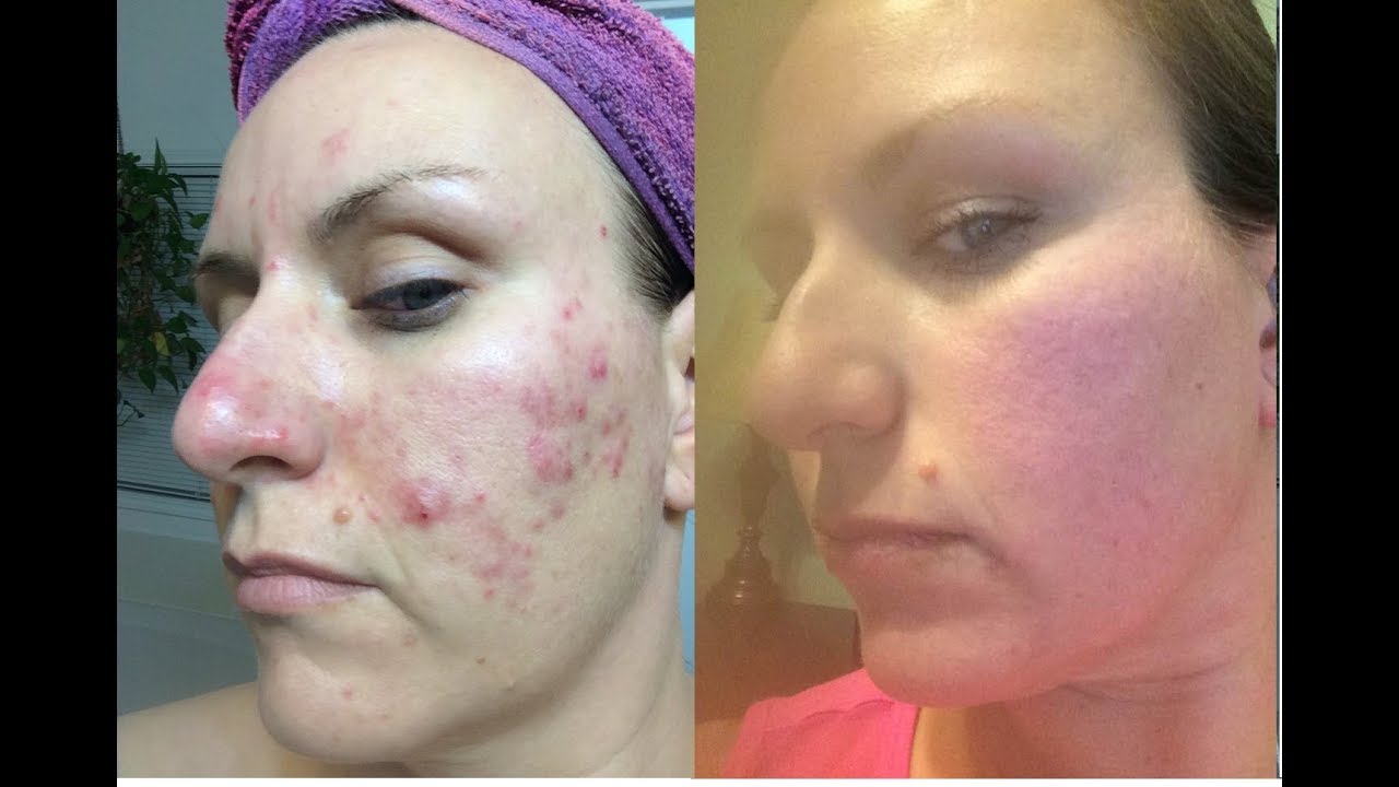 Roaccutane 40mg