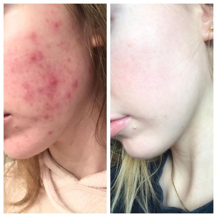 Accutane Farmacia Online