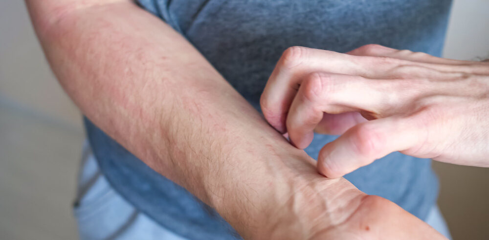 isotretinoin on-line