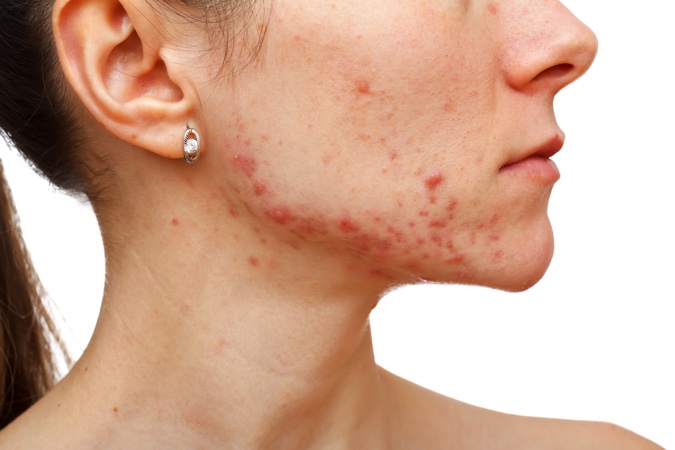 Isotretinoin sin receta