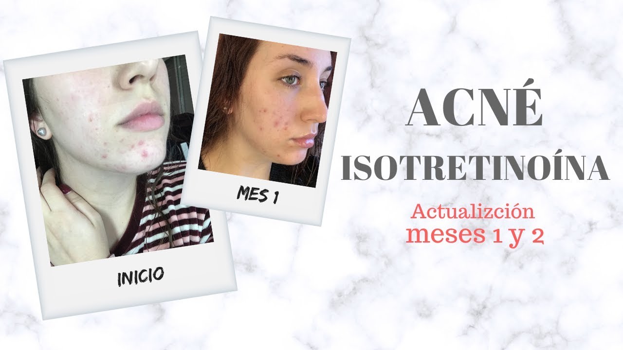 Isotretinoina Vastionin Precio