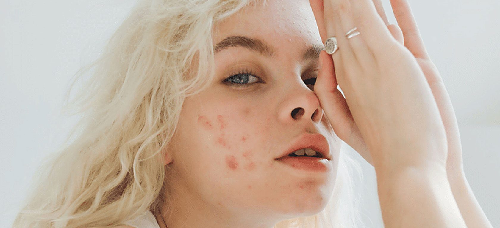 roaccutane donde comprar